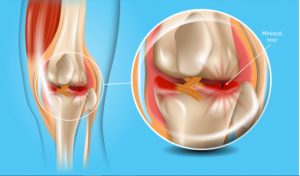 chấn thương sụn chêm